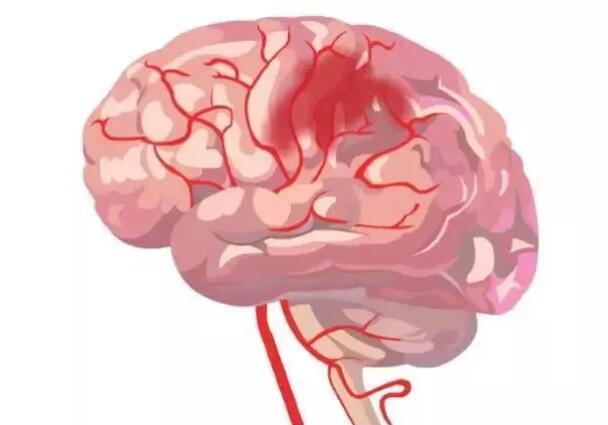 脐带干细胞治疗脑卒中,帮助卒中病人恢复健康 脐带干细胞治疗脑卒中,帮助卒中病人恢复健康