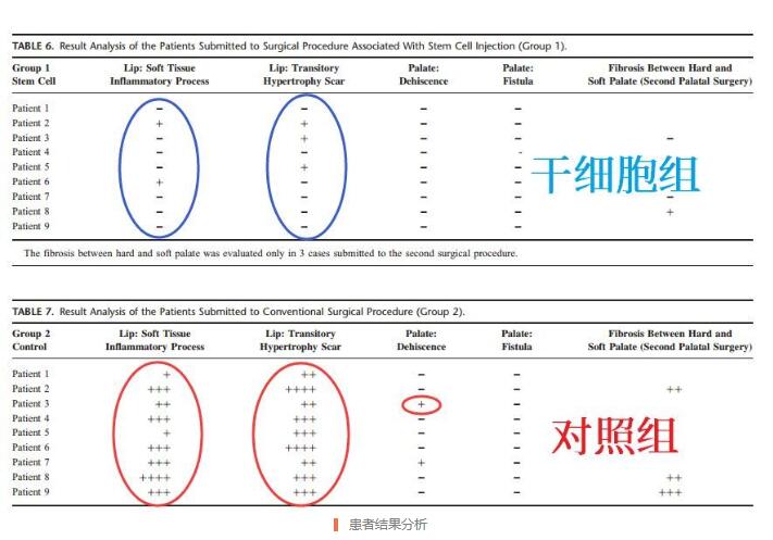 研究证实:脐带血或脐带是唇腭裂治疗中理想的干细胞来源 研究证实:脐带血或脐带是唇腭裂治疗中理想的干细胞来源